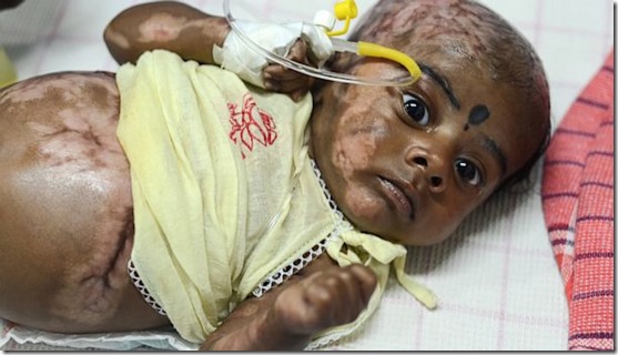 bebe combustao espontanea thumb Médicos investigam bebê indiano que teria sofrido combustão espontânea