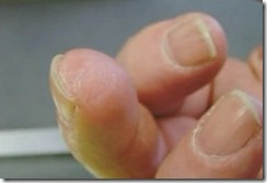 dedo thumb Médico usa uma nova tecnologia para dedo de homem ‘voltar a crescer’