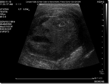rosto ultrassom thumb Rosto humano aparece em ultrassom de tumor